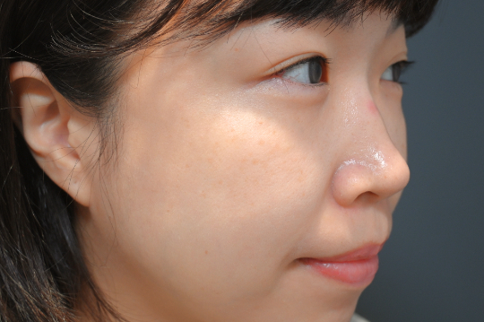 佳飛雅緻美學｜蜂巢皮秒｜施欣辰01